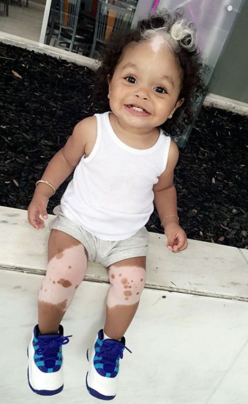 Little Girl Born With A White Patch Of Hair Just Like Her Mom (7 pics)