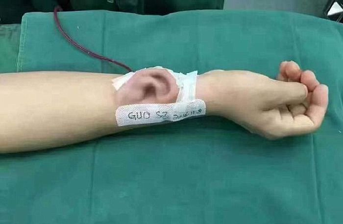 Chinese Doctor Grows Ear On Man's Arm To Help Restore His Hearing (3 pics)