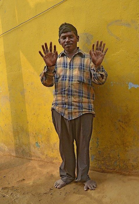 Everyone In This Indian Family Has 12 Fingers And 12 Toes (13 pics)