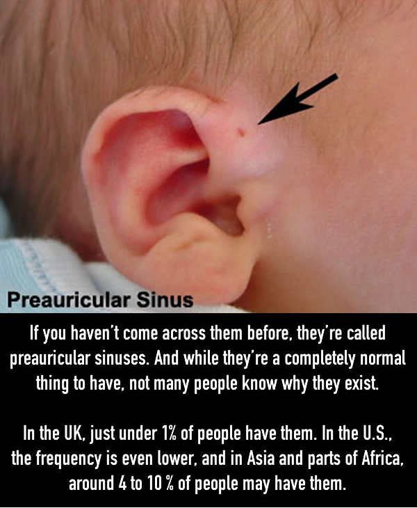 The Reason Why Some People Have Little Holes Above Their Ears (5 pics)