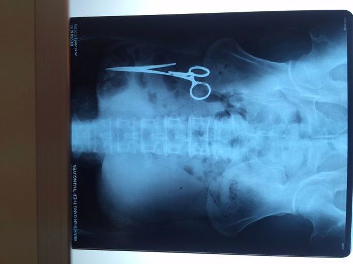 Vietnam Medics Remove Scissors From Man After 18 Years (3 pics)