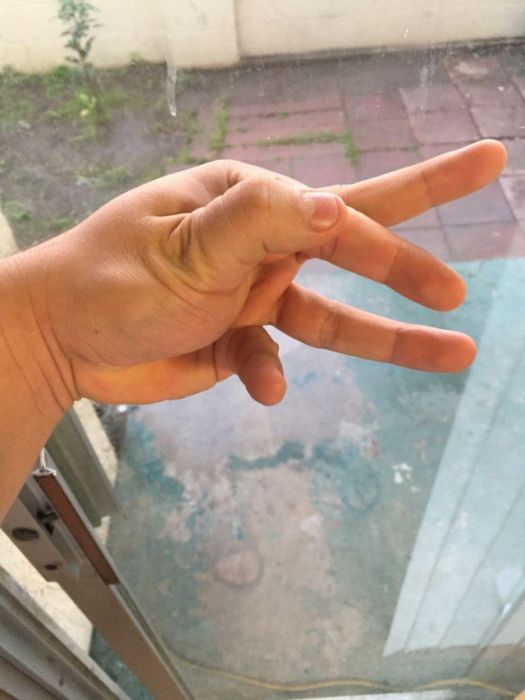 How To Dislocate Your Thumb (14 pics)