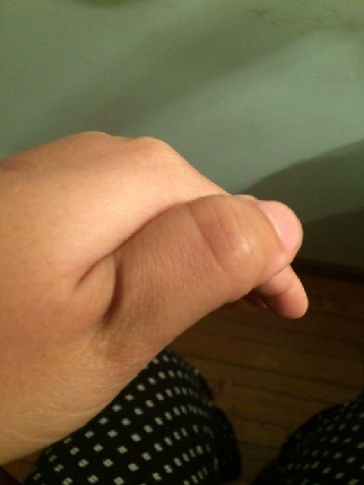 How To Dislocate Your Thumb (14 pics)