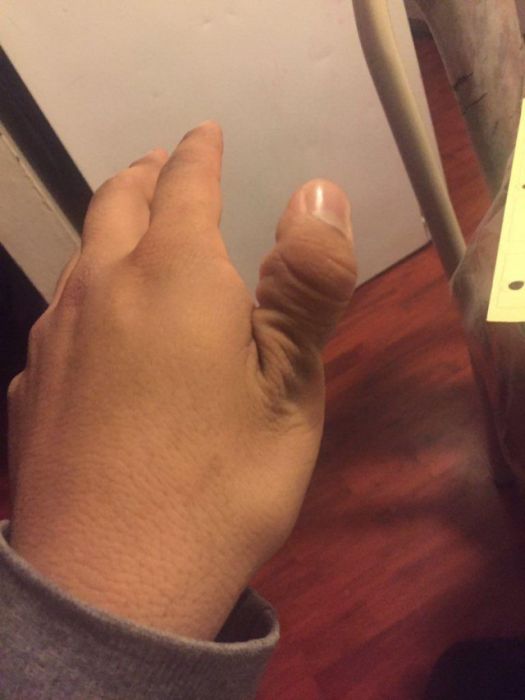 How To Dislocate Your Thumb (14 pics)