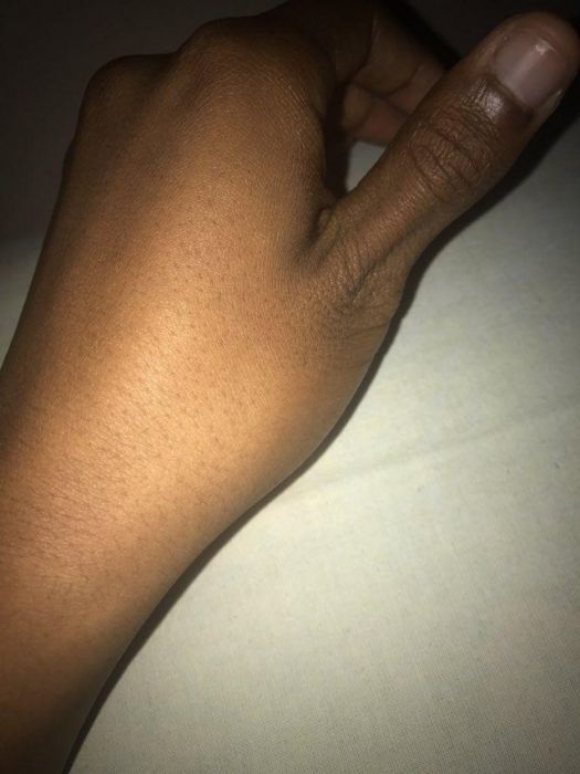 How To Dislocate Your Thumb (14 pics)