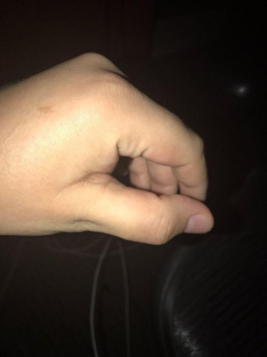 How To Dislocate Your Thumb (14 pics)