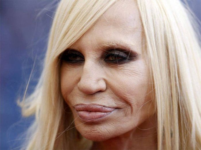 Irreversible Plastic Surgery Fails That Are Straight Up Scary (39 pics)