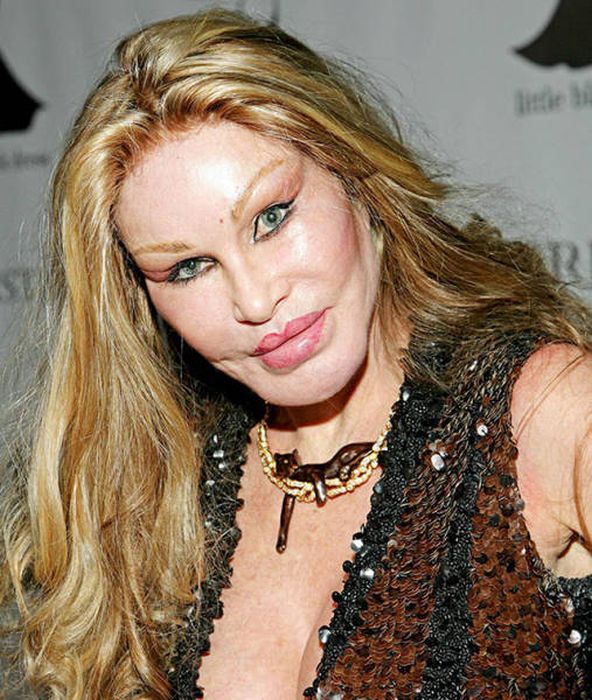 Irreversible Plastic Surgery Fails That Are Straight Up Scary (39 pics)