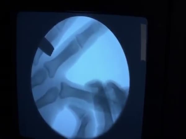 Flexing Your Knuckles Under A Fluoroscope