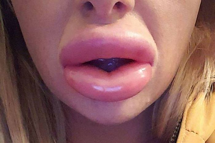 This Woman Will Never Try To Save Money On Plastic Surgery Again (8 pics)