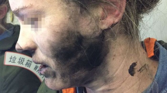 Woman Gets Burned By Exploding Headphones (2 pics)