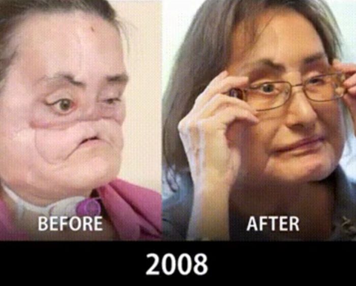 How Face Transplants Have Evolved (9 pics)