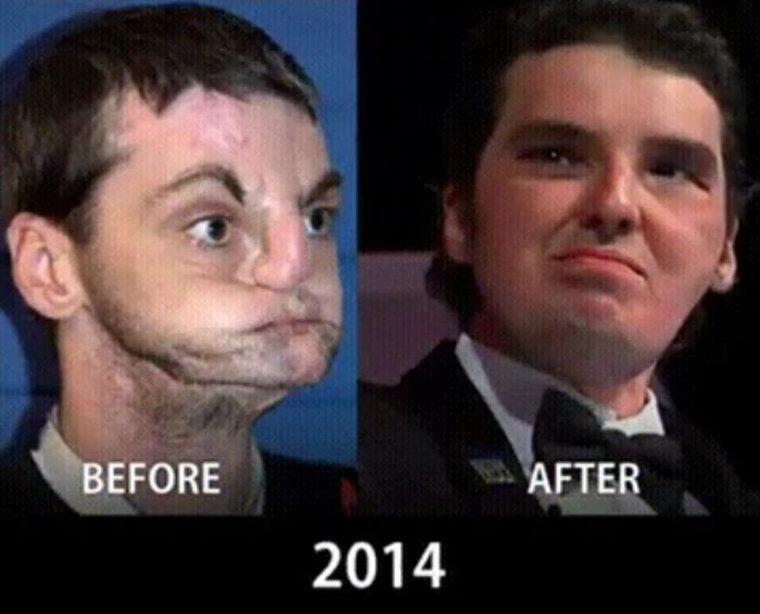 How Face Transplants Have Evolved (9 pics)