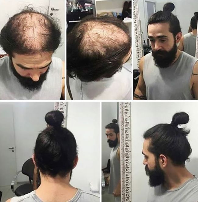 Men Are Trying To Hide Baldness With Man Buns Now (5 pics)