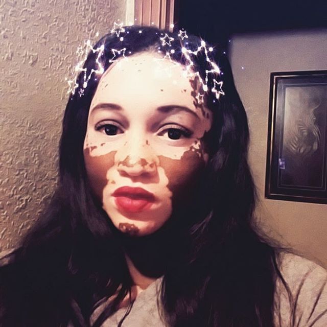 Woman With Vitiligo Becomes A Model (19 pics)
