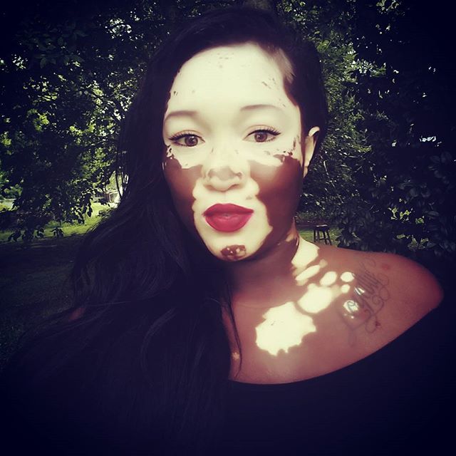 Woman With Vitiligo Becomes A Model (19 pics)