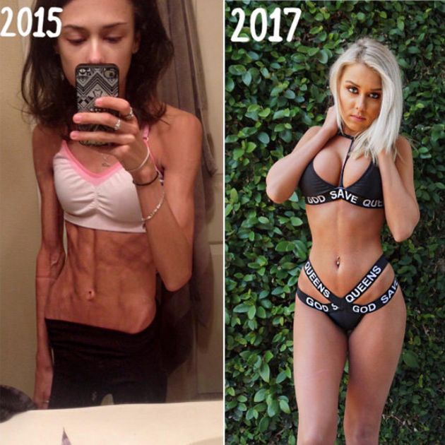Woman Shares Her Amazing Story After Beating Anorexia (3 pics)