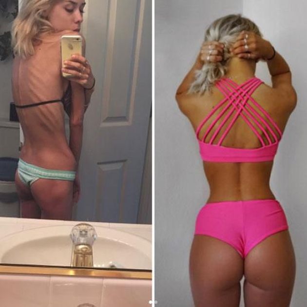 Woman Shares Her Amazing Story After Beating Anorexia (3 pics)