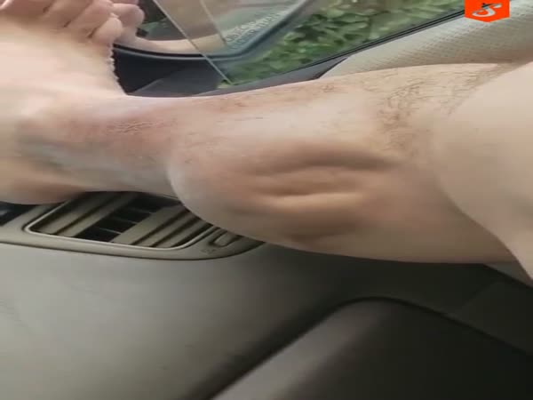 Man's Disturbing Leg Cramp After Intense GYM Workout
