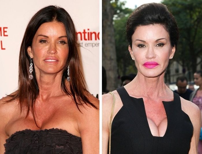 Celebrity Before And After Plastic Surgeries (10 pics)