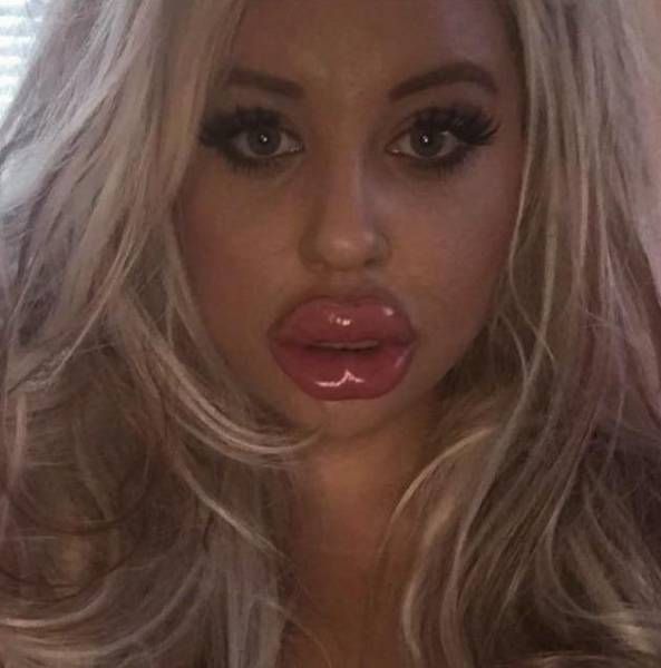 Silicone Beauties Or Horror Stories (22 pics)