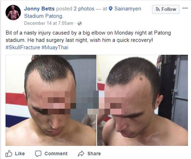 Muay Thai Fighter Suffers Horrific Injury After Getting Elbowed In The Head (3 pics)