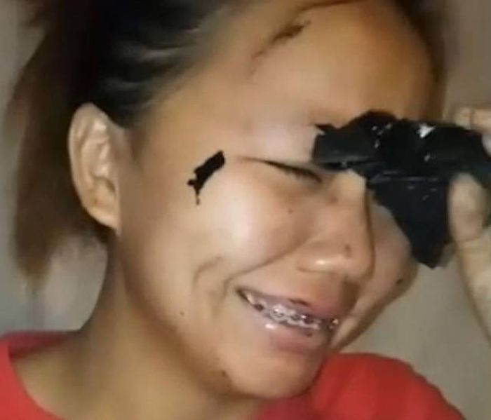 This Girl Wanted To Get Rid Of Acne But Lost Her Eyebrows (8 pics)