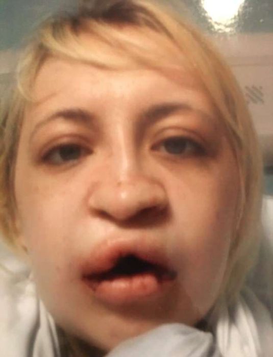 It Took 10 Operations For A Girl With A Wolf Mouth To Change (11 pics)
