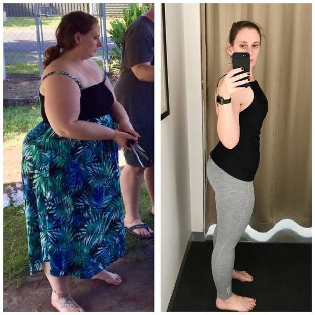 This Girl Lost A Lot Of Weight But There Is Another Problem Now (3 pics)