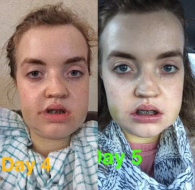 Before And After A Plastic Surgery (8 pics)