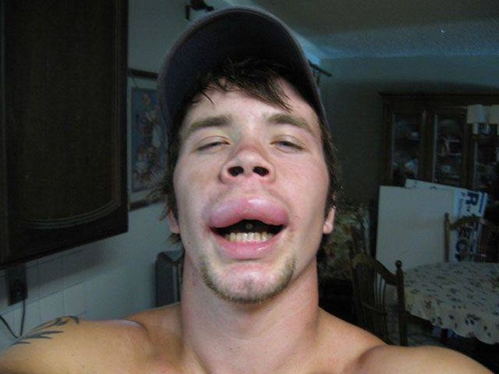 When Allergy Strikes (19 pics)