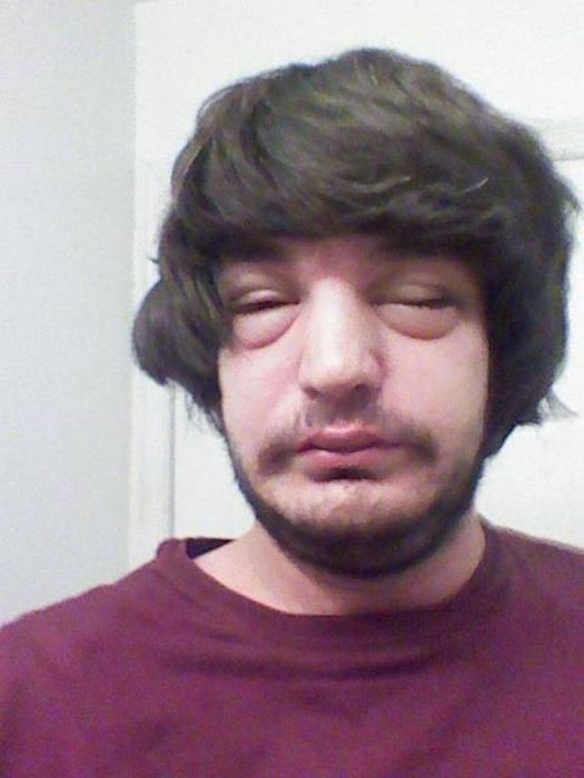 When Allergy Strikes (19 pics)
