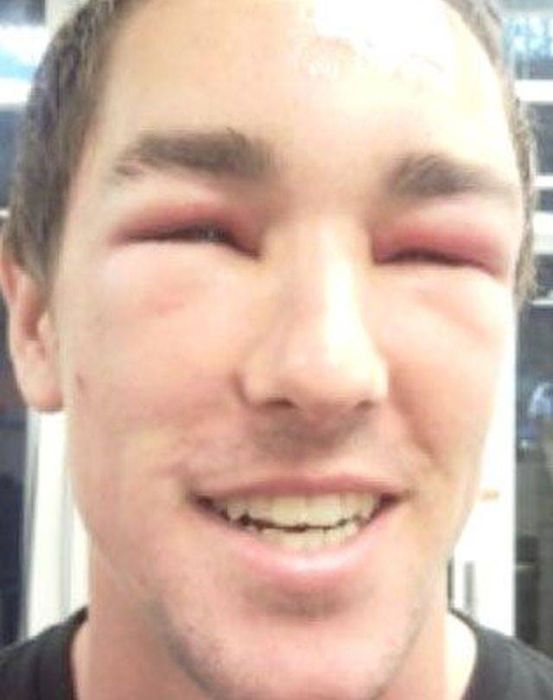 When Allergy Strikes (19 pics)