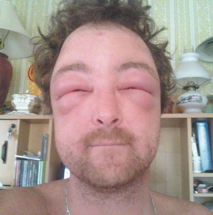 When Allergy Strikes (19 pics)