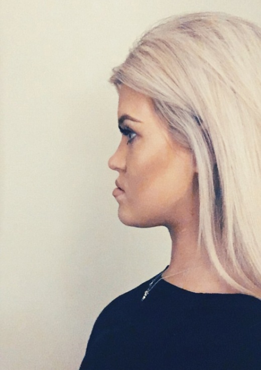 Girl Before And After Face Plastic Surgery (13 pics)