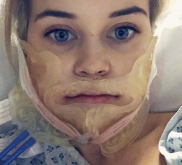 Girl Before And After Face Plastic Surgery (13 pics)