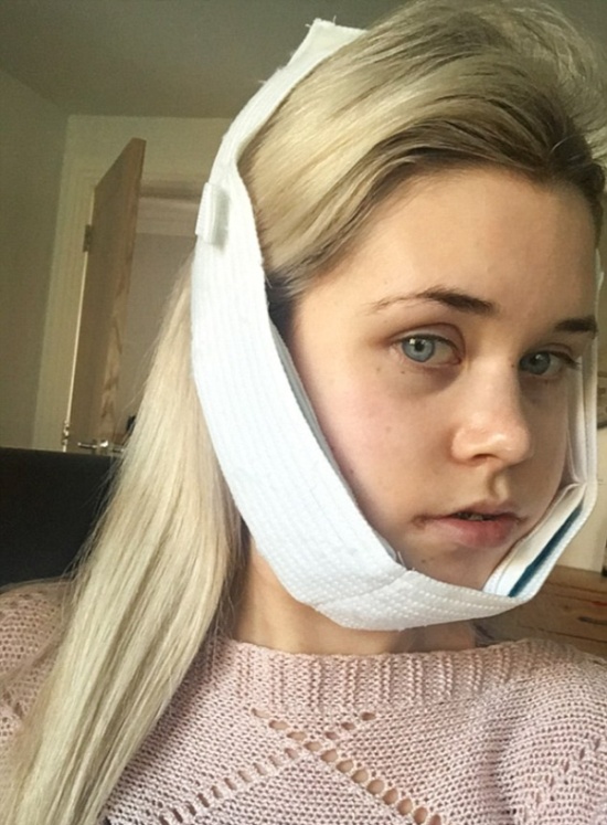 Girl Before And After Face Plastic Surgery (13 pics)