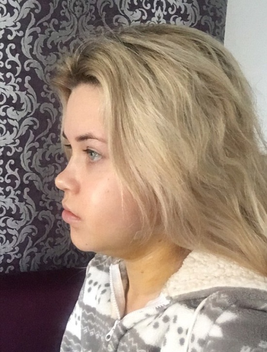 Girl Before And After Face Plastic Surgery (13 pics)
