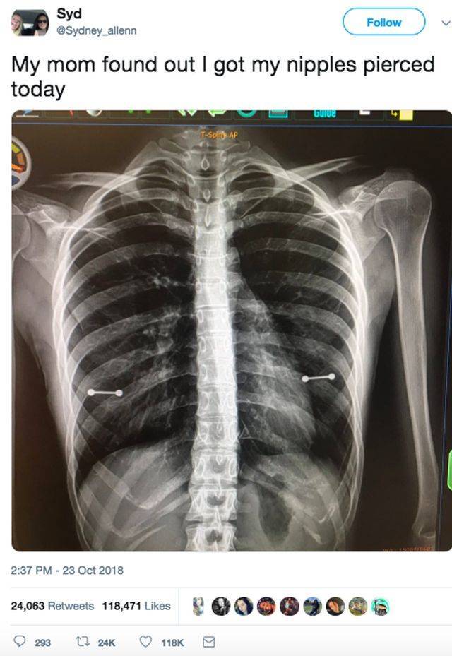 A Mother Accidentally Discovers With An X-Ray That Her 20-Year-Old Daughter Had Her Nipples Pierced (2 pics)