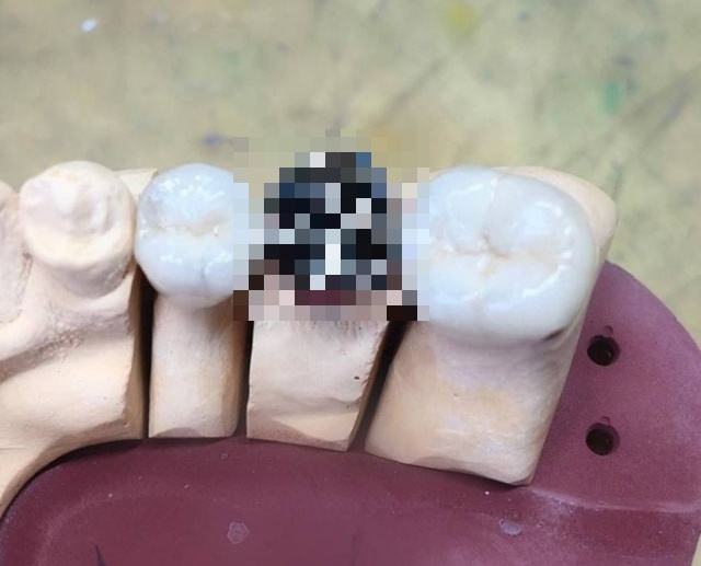 Skull Tooth Crowns (3 pics)