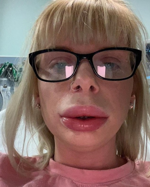 Woman Was Left With Swollen Lips Because Of Numbing Cream Used As Part of At-home Lip Fillers (3 pics)