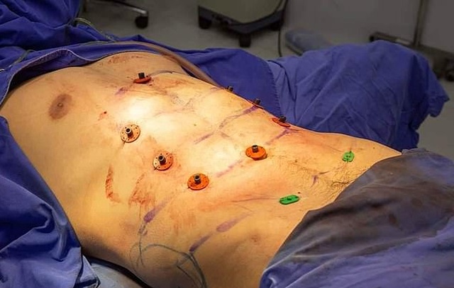 24-year-old Man Spent $4,000 On Surgery To Have Fake Stomach Muscles (9 pics)