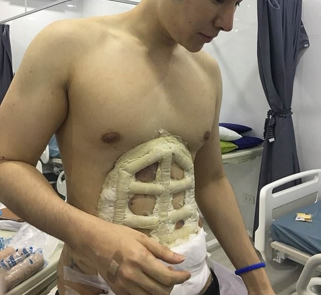 24-year-old Man Spent $4,000 On Surgery To Have Fake Stomach Muscles (9 pics)