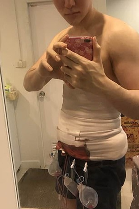 24-year-old Man Spent $4,000 On Surgery To Have Fake Stomach Muscles (9 pics)