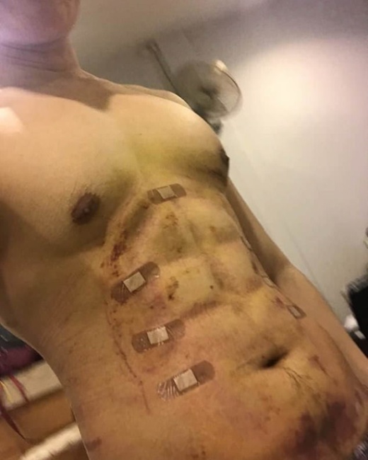 24-year-old Man Spent $4,000 On Surgery To Have Fake Stomach Muscles (9 pics)