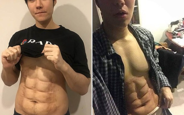 24-year-old Man Spent $4,000 On Surgery To Have Fake Stomach Muscles (9 pics)