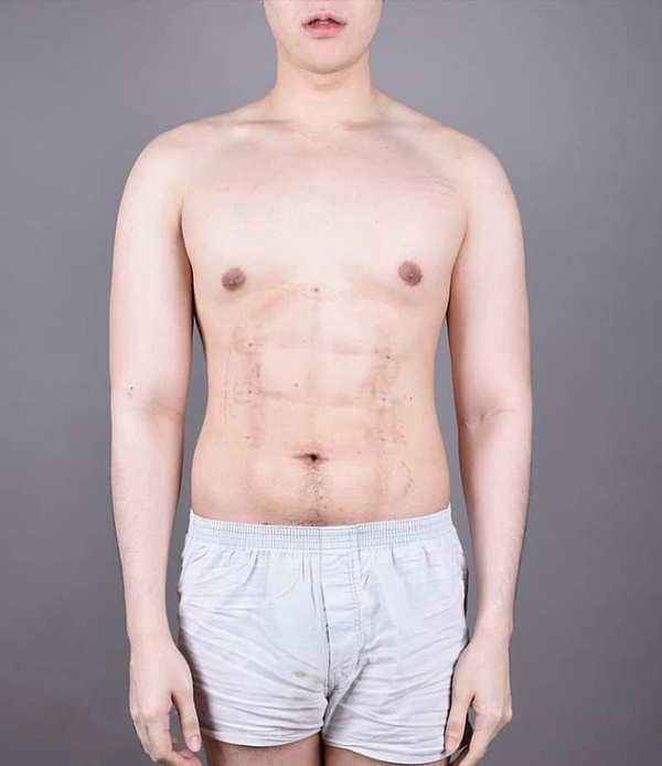 24-year-old Man Spent $4,000 On Surgery To Have Fake Stomach Muscles (9 pics)