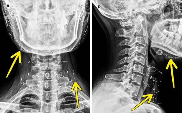 Interesting X-Rays And Scans (22 pics)