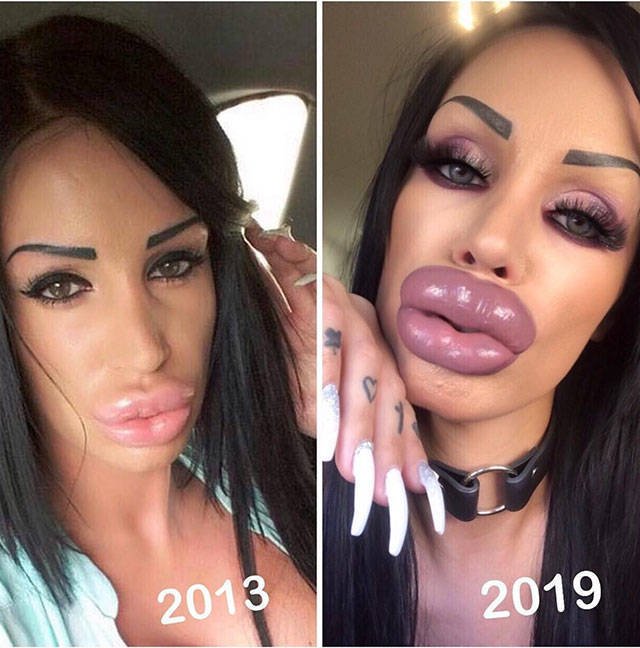 Plastic Surgery Went Wrong (20 pics)