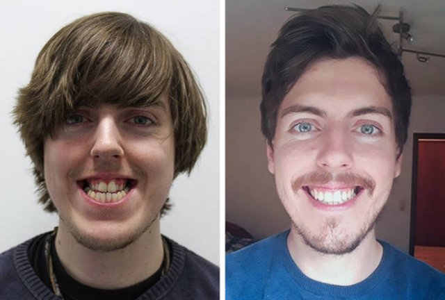 Then And Now: People Fix Their Smiles (23 pics)
